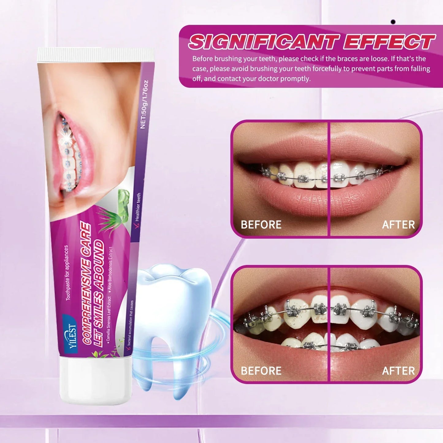 Toothpaste for Braces &amp; Aligners – Gentle Whitening Formula 50g | Removes Stains