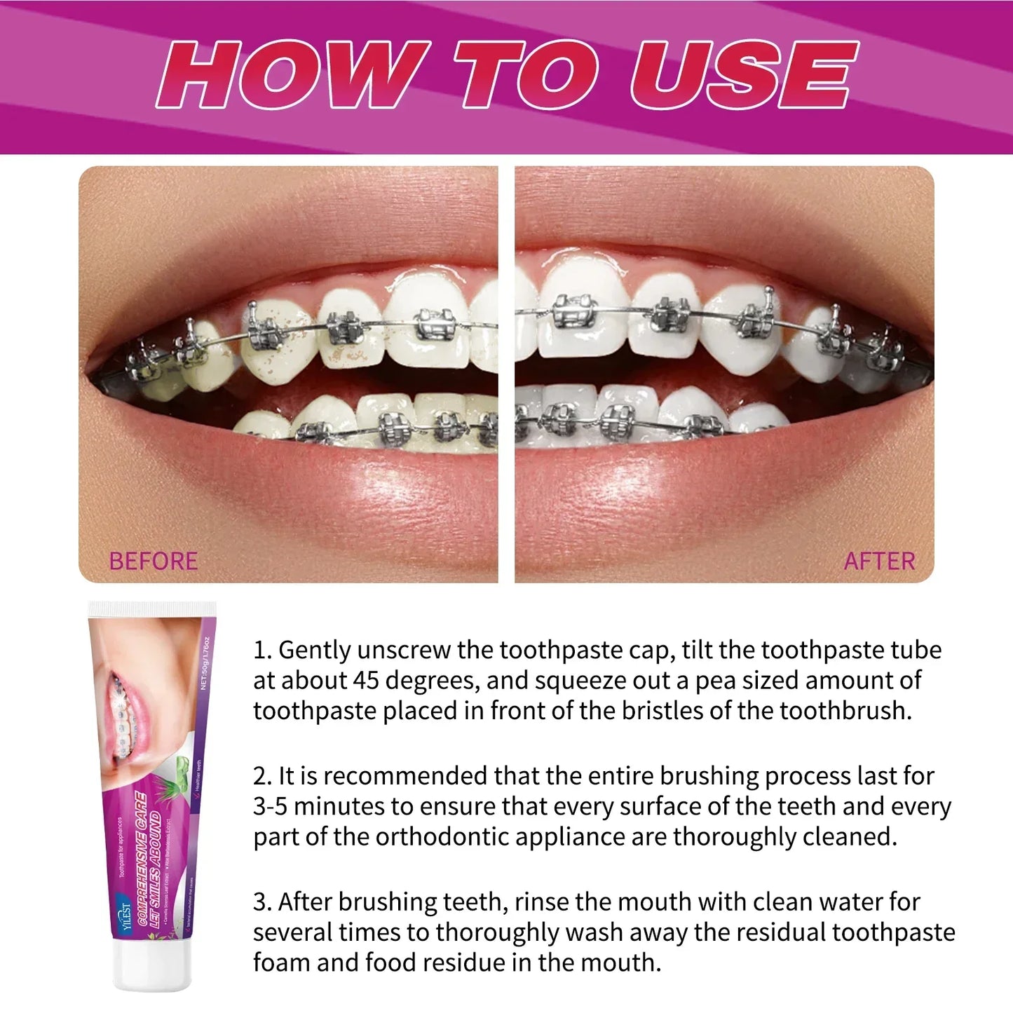 Toothpaste for Braces &amp; Aligners – Gentle Whitening Formula 50g | Removes Stains